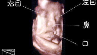 妊婦健診　胎児のエコー3D写真